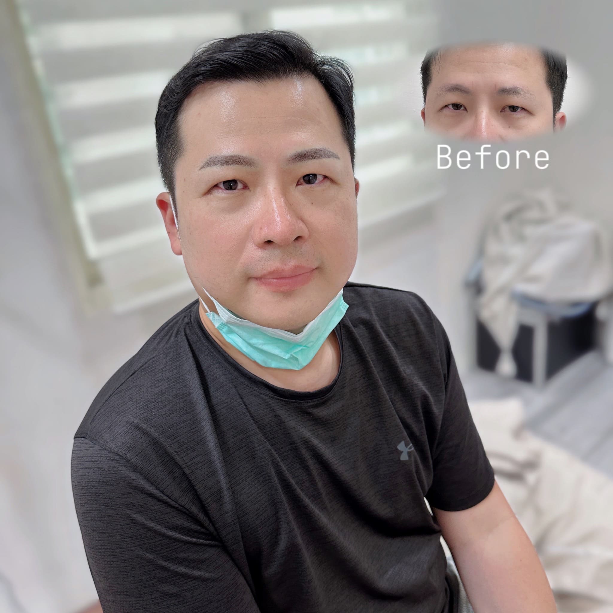 霧眉前後對比照片