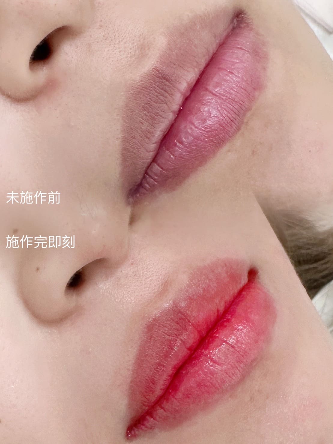 霧唇前後對比照片